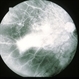 Radiation Retinopathy Radiation Retinopathy